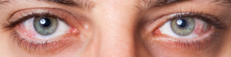 Eye Infections from Contacts and Their Causes