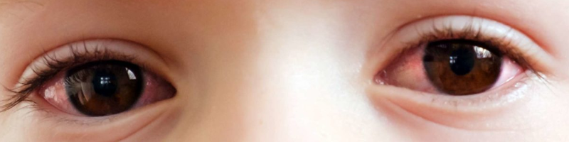 What Causes Pink Eye?