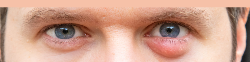 What is a Chalazion Gland, and How to Treat It?