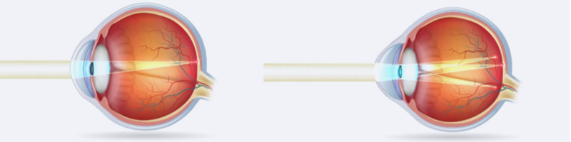 What is Astigmatism?