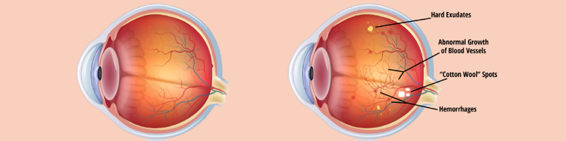 What is Diabetic Retinopathy?