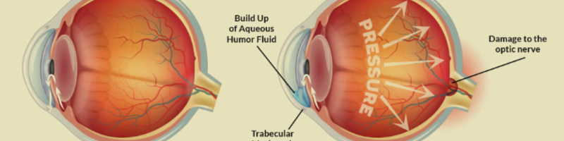 What is Glaucoma?