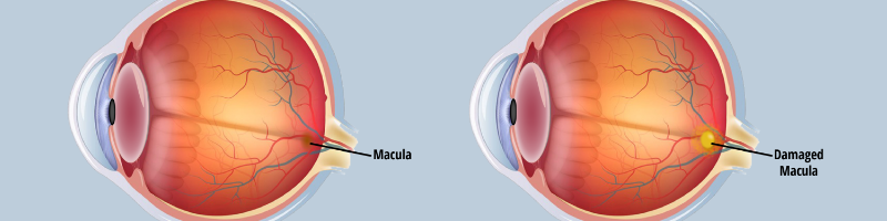 What is Macular Degeneration